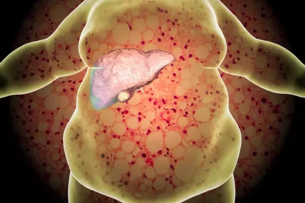 Karaciğer Yağlanması